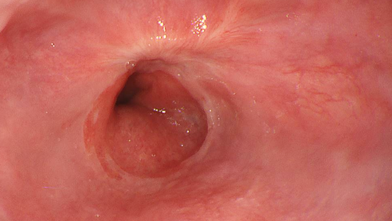 内視鏡的逆流防止粘膜切除術　“ESD-G法”