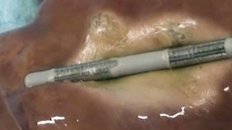 ERCP下腫瘍ラジオ波焼却術